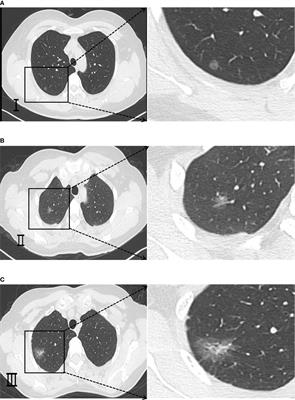 Expression and clinical significance of CD31, CD34, and CD105 in pulmonary ground glass nodules with different vascular manifestations on CT